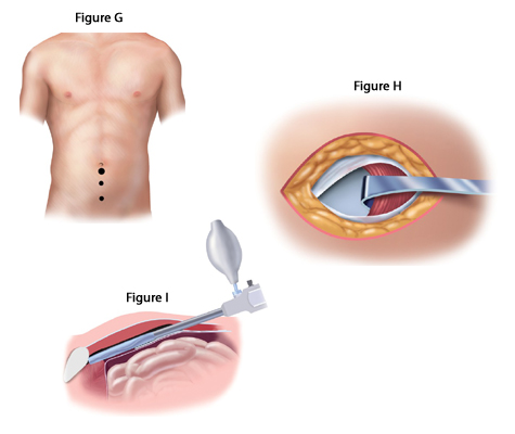 Laparoscopic Inguinal Hernia Repair